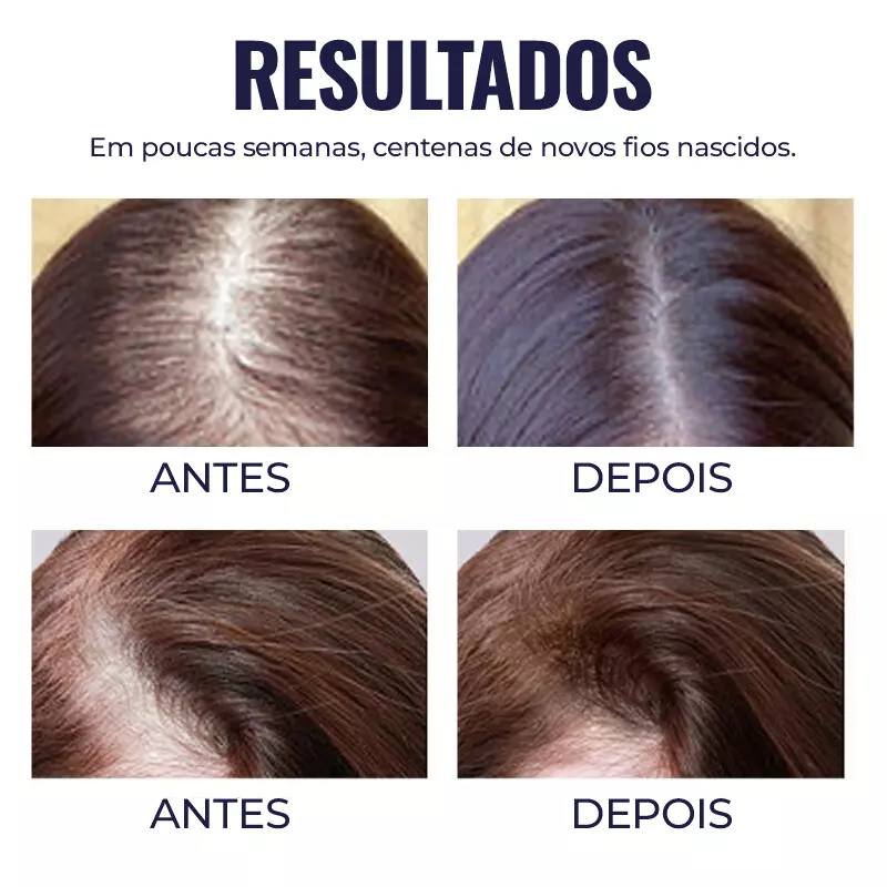 Sérum Crescimento Capilar - Blusoms® [ÚLTIMO DIA DE PROMOÇÃO]